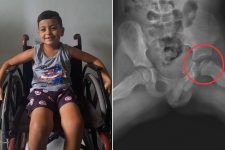 menino-e-diagnosticado-com-doenca-‘incomum’-e-tratamento-preve-que-ele-fique-ate-quatro-anos-sem-andar